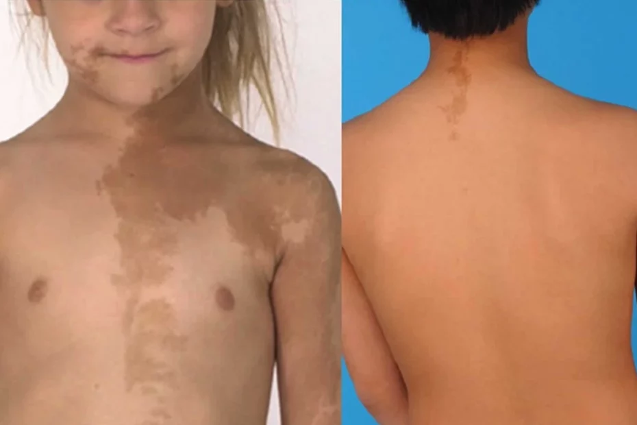 imagens de crianças com síndrome de McCune-Albright no peito e nas costas.